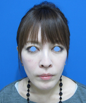 目の下のたるみ、目のくまでお悩みの方、切らずに完璧に解決します。TCB-R法　手術直後　症例写真